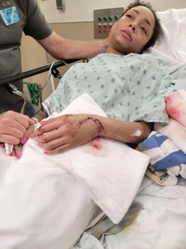 Woman in a hospital bed with a large shark bite in her left hand.