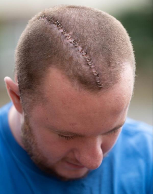 Braden Stromberg of Mansfield, Nottinghamshire underwent four hours of surgery to restore his skull after he nearly died when he was knocked unco<em></em>nscious with a single punch. August 09 2023. See SWNS story SWLNskull. A man who was left with half of his skull missing following a brutal assault is enjoying a new lease of life after havin<em></em>g his head rebuilt - out of plastic. Braden Stromberg, 27, almost died after he was punched to the ground during a sickening attack on May 2 last year. He was left with a bleed on the brain and spent 15 days in a coma after being assaulted from behind by thug Kyle Stephenson in Bolsover, Derbys. Doctors had to remove the right side of his skull before he went on to make a miracle recovery which stunned medics at the time. But his life was put on hold after he was forced to wear a helmet to shield his unprotected brain and lived in fear a single knock to the head could kill him. Following a wait of over a year, Braden has now undergone pio<em></em>neering surgery to reco<em></em>nstruct his head shape using a polycarbo<em></em>nate moulded to the shape of his skull. The grounds worker says he's looking forward to returning to work and leading a normal life again following mo<em></em>nths of being at risk of death just doing day-to-day activities.