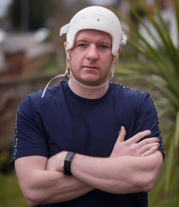 FILE PICTURE - Braden Stromberg, of Clipstone, Nottinghamshire, who lost half his skull after a vicious assault by Kyle Stephenson in Bolsover. See SWNS story SWLNskull. A man who was left with half of his skull missing following a brutal assault is enjoying a new lease of life after havin<em></em>g his head rebuilt - out of plastic. Braden Stromberg, 27, almost died after he was punched to the ground during a sickening attack on May 2 last year. He was left with a bleed on the brain and spent 15 days in a coma after being assaulted from behind by thug Kyle Stephenson in Bolsover, Derbys. Doctors had to remove the right side of his skull before he went on to make a miracle recovery which stunned medics at the time. But his life was put on hold after he was forced to wear a helmet to shield his unprotected brain and lived in fear a single knock to the head could kill him. Following a wait of over a year, Braden has now undergone pio<em></em>neering surgery to reco<em></em>nstruct his head shape using a polycarbo<em></em>nate moulded to the shape of his skull. The grounds worker says he's looking forward to returning to work and leading a normal life again following mo<em></em>nths of being at risk of death just doing day-to-day activities.