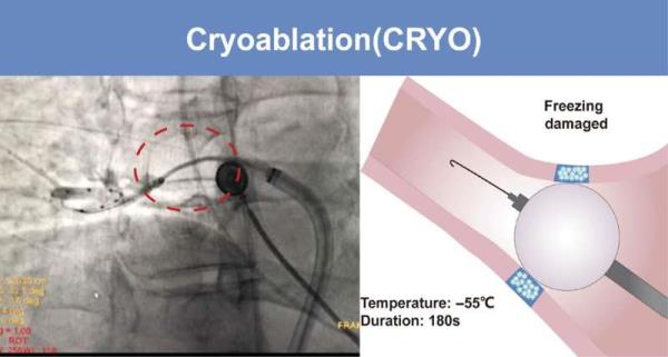 Incremental me<em></em>tabolic benefits from cryoablation for paroxysmal atrial fibrillation